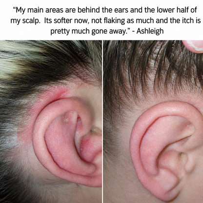 ClearScalp Cream