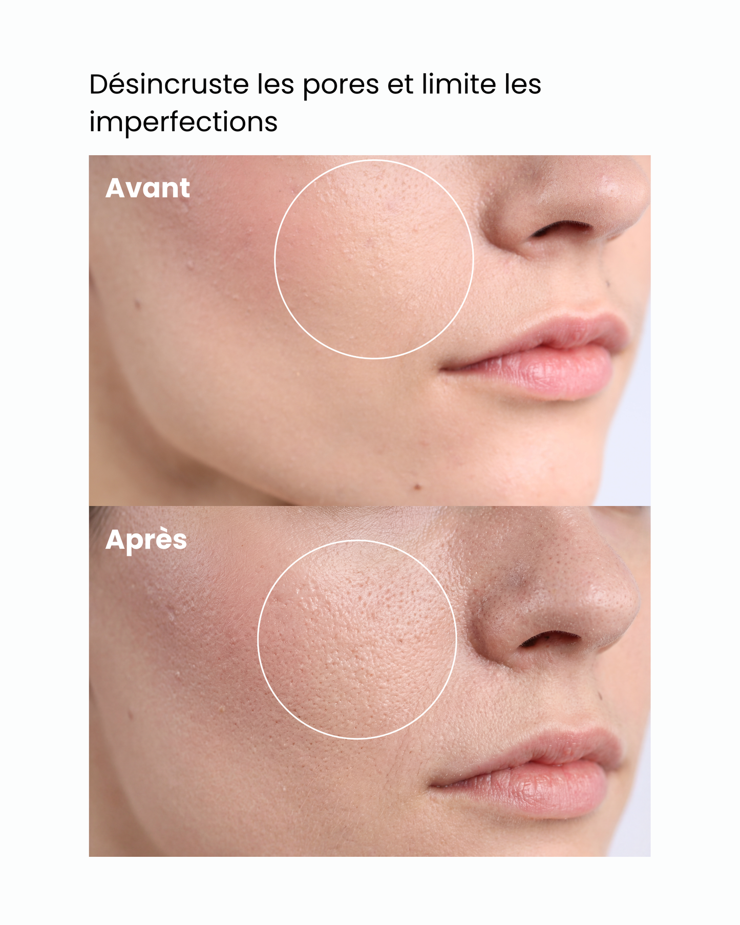 Sérum purifiant – Désincruste les pores et limite les imperfections