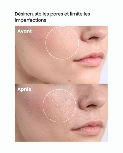 Sérum purifiant – Désincruste les pores et limite les imperfections